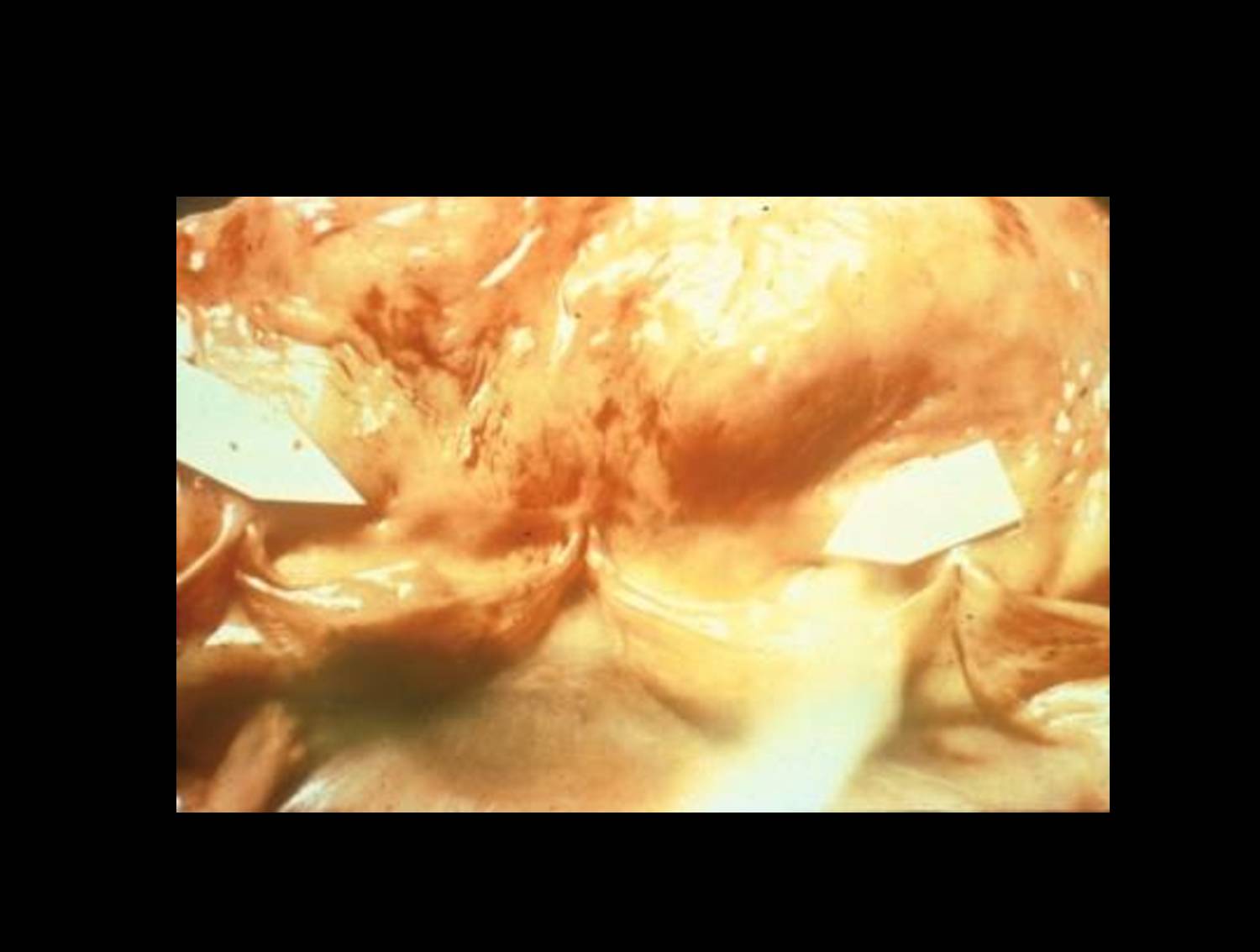 Secondary syphilis pustular rash showing pustular lesions on erythematous base with crusting characteristic of severe spirochete dissemination